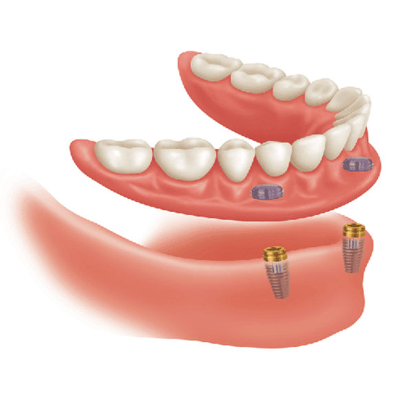 Implant Retained Fixed Prosthesis