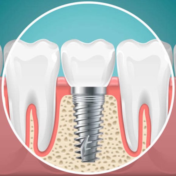 Implants Surgery